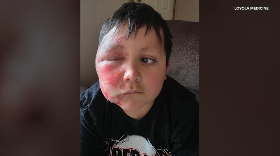 9-year-old boy suffers severe burns to face while imitating TikTok trend