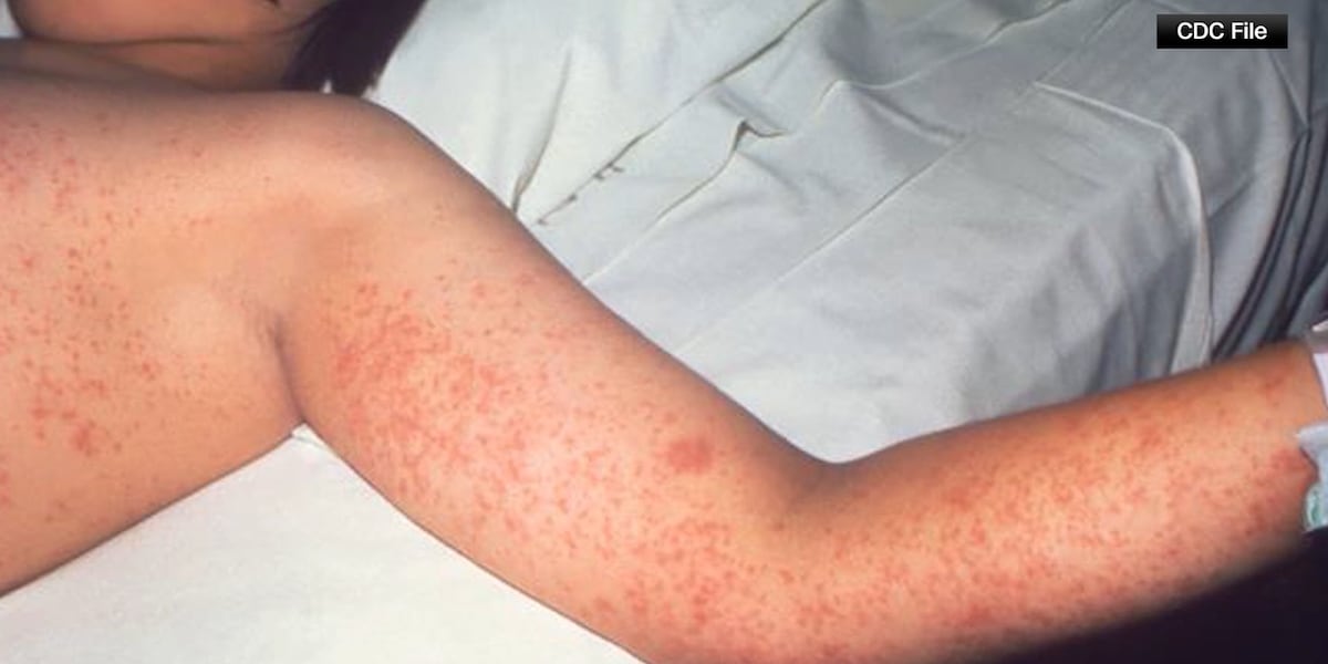 Medical experts give insight on measles in the U.S. to help Mainers stay cautious
